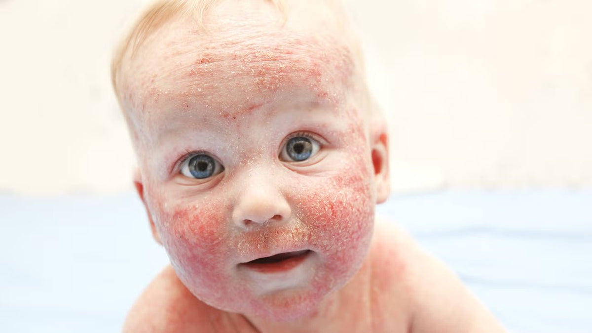 Newborn Rash: Causes, Prevention & Best Creams to Use - The Happy Baby Store